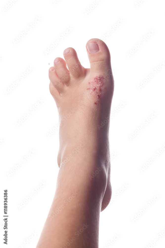 Eczema, atopic dermatitis. Close up of eczema on the skin of the Eczema, atopic dermatitis. Close up of eczema on the skin of the