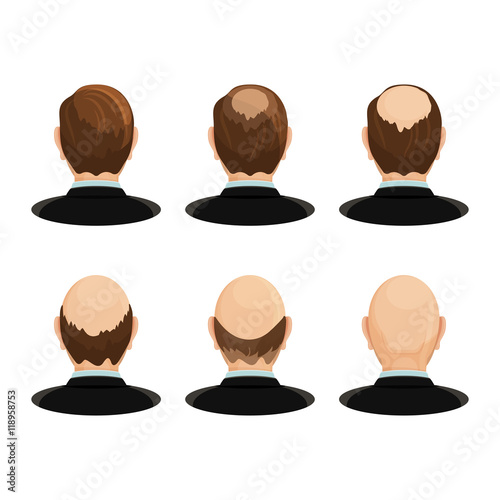 Alopecia concept. Set of heads showing the hairloss progress.