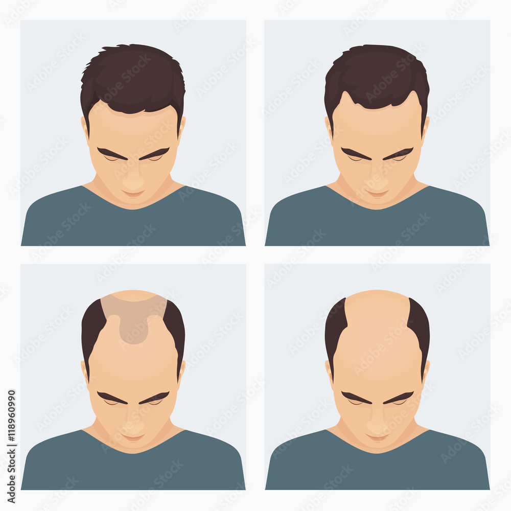 Male hair loss stages set. Male pattern baldness. Different stages of hair  loss in man. Transplantation of hair. Human hair growth. Hair care concept.  Vector illustration. Stock Vector | Adobe Stock