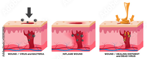 wound , inflame wound , healing ointment vector , anatomy