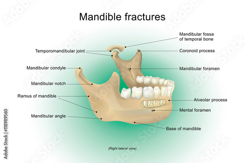 Mandible fractures