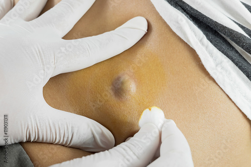Doctor Diagnosis of the Sebaceous on Woman's Back photo