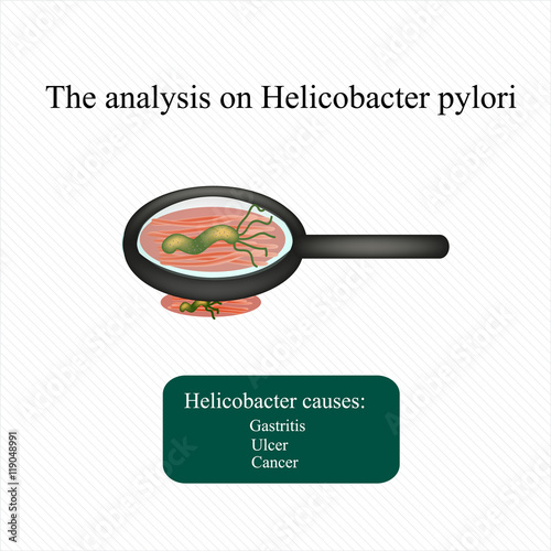The analysis on Helicobacter pylori. Infographics. Vector illustration
