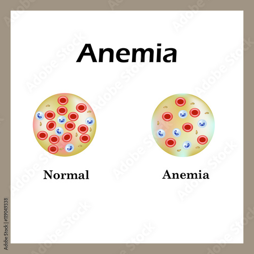 Anemia. The reduced amount of red blood cells. Infographics. Vector illustration