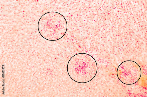 Coccidiosis, coccidia in liver (marked with circles), illustration based on light micrograph, magnification X50, labeled. There is duct hyperplasia and fibrosis with periductal inflammation photo