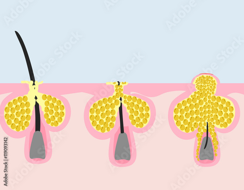 Acne development