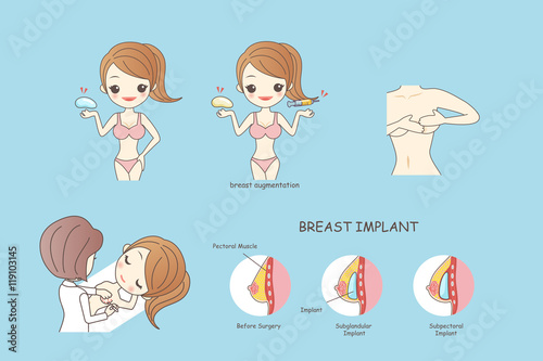 cartoon woman doing breast implant