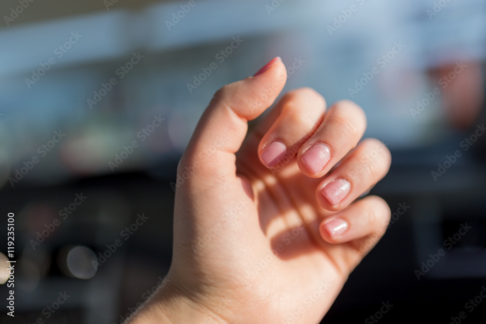 Womans hands with problem with nails. Allergy on gel nails. Cutt Womans hands with problem with nails. Allergy on gel nails. Cutt