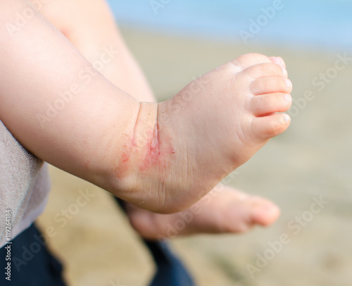 atopic dermatitis newborn feet eczema photo