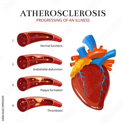 Atherosclerosis, blood clot formation. Vector medical illustration photo