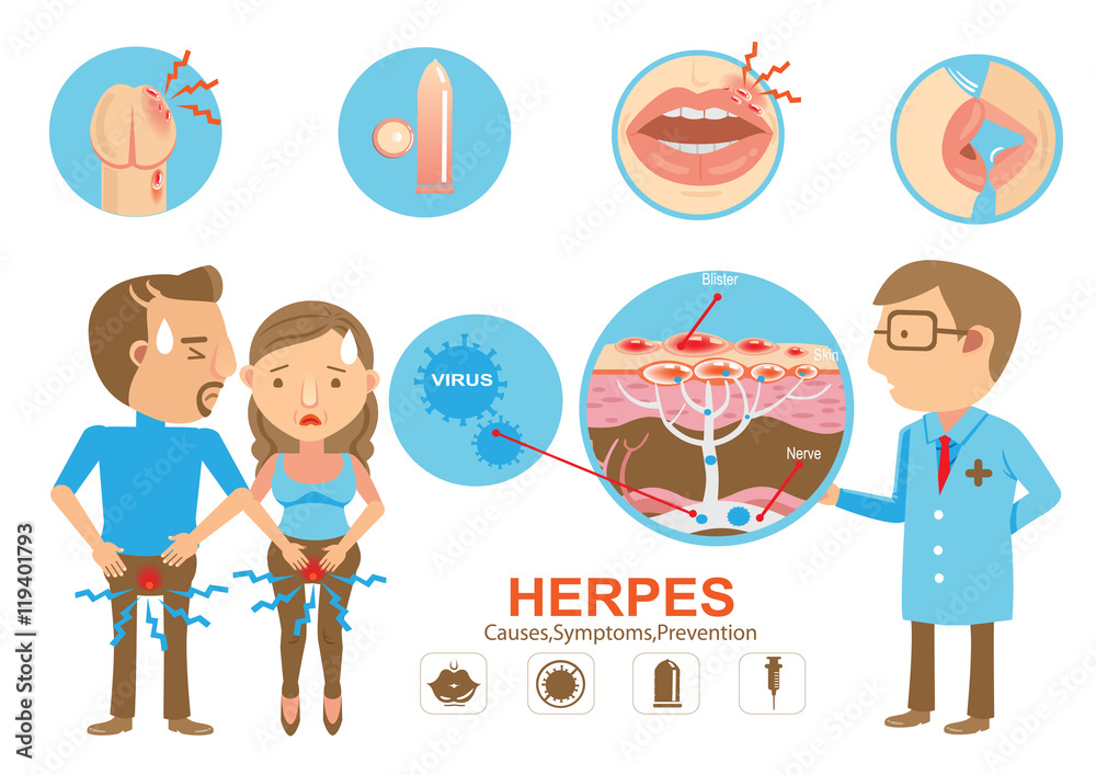 Herpes/Doctor holding diagram Herpes on the lips and genitals of the young woman And young men. Cartoon vector illustration And genitals Herpes/Doctor holding diagram Herpes on the lips and genitals of the young woman And young men. Cartoon vector illustration And genitals