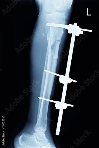 closed fracture tibia and fibula left lef