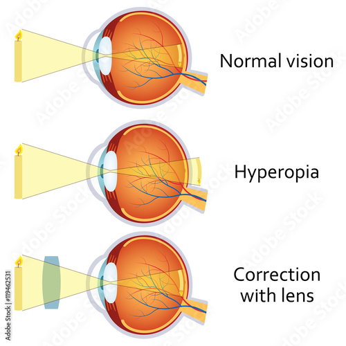 Hyperopia corrected by a plus lens.