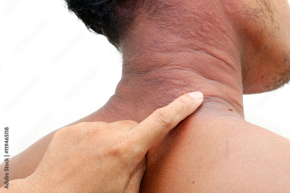 Allergy rash Allergy rash