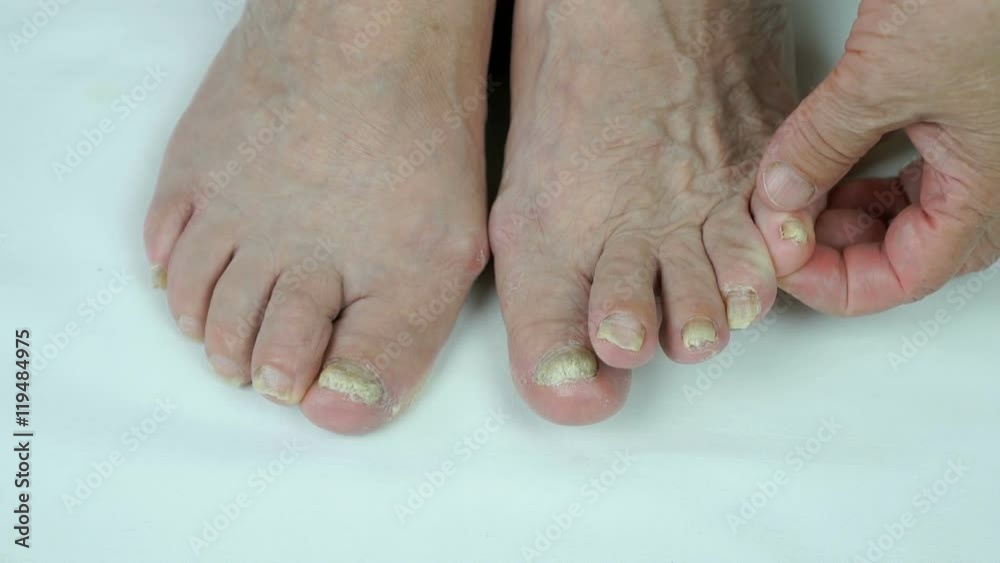 Fungal infection on nails of foot Fungal infection on nails of foot