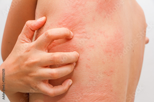 Women with symptoms of itchy urticaria. photo