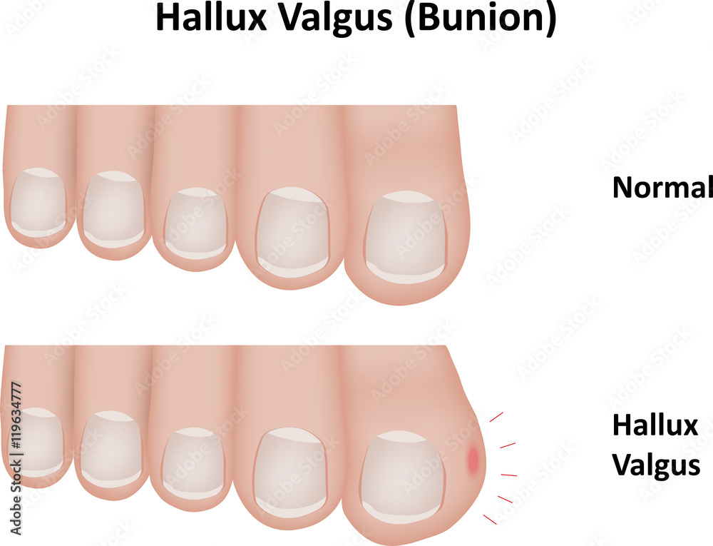 Hallux Valgus Bunion Hallux Valgus Bunion
