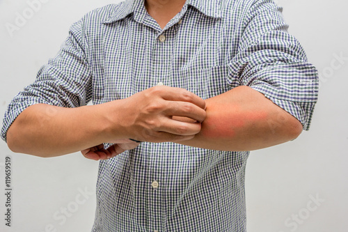 men scratch the itch with hand ,arm, itching, Concept with Healthcare And Medicine.