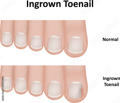 Ingrown Toenail