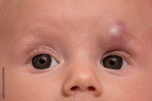 Infant hemangioma on forehead of baby girl, treatment with propr