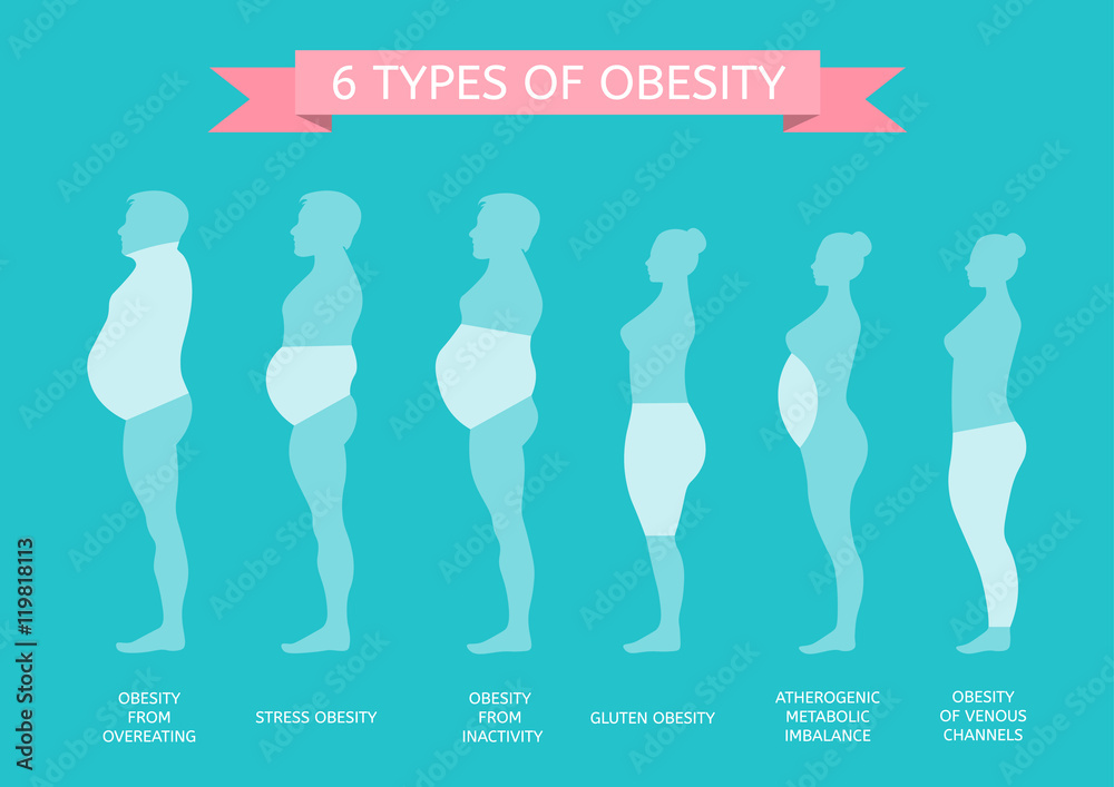 6 Types Of Obesity Male And Female Figure In Profile Stock Vector 6 Types Of Obesity Male And Female Figure In Profile Stock Vector