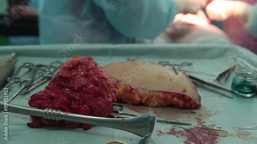 carved into pieces of human flesh liposuction