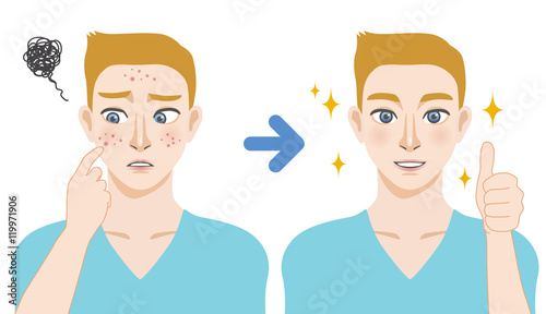 young boy acne treatment before and after, facial cleansing foam, men's skin care, cartoon illustration