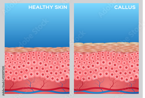 callus skin anatomy and healthy skin photo