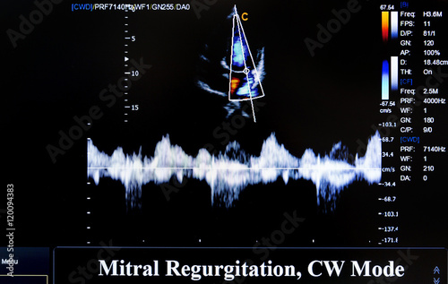 Colourful ultrasound monitor image. Mitral Regurgitation