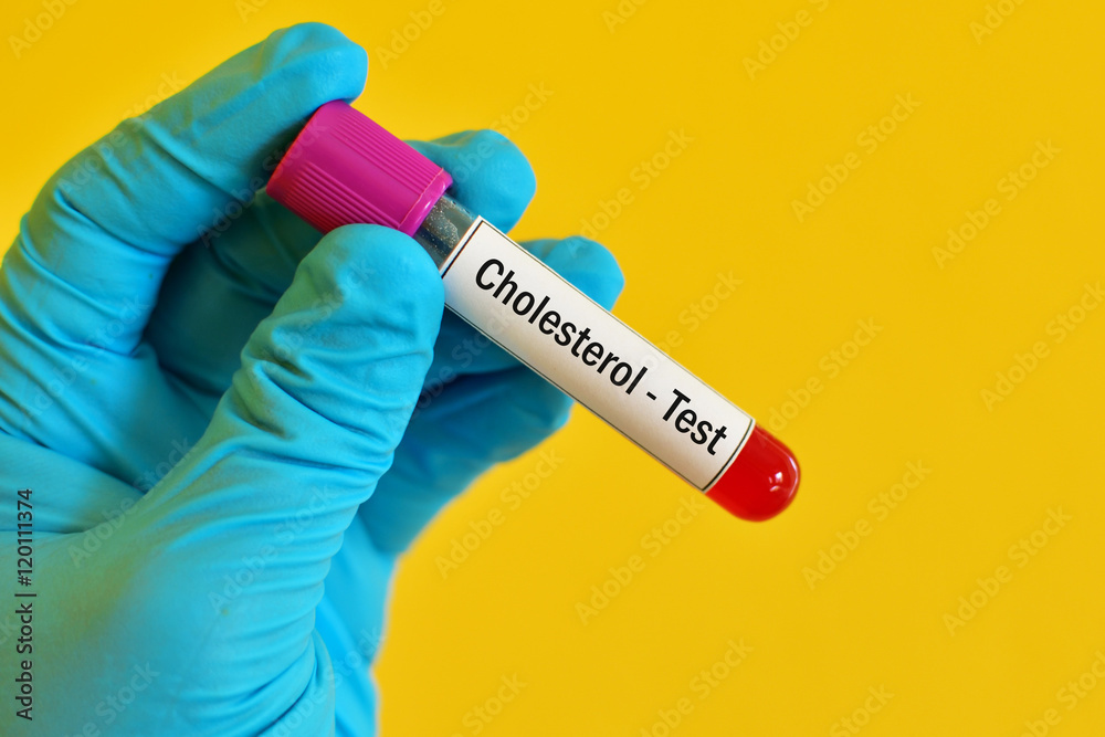 Fototapeta premium Blood sample for cholesterol test 
