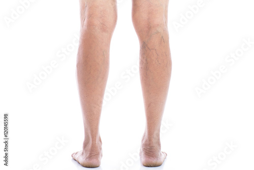 Varicose vein Isolated on white