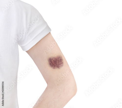 Woman arm with heart-shaped bruise - gender issues concept 