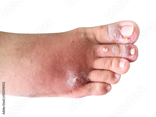 human foot and ingrown nail, onychocryptosis isolated on white b