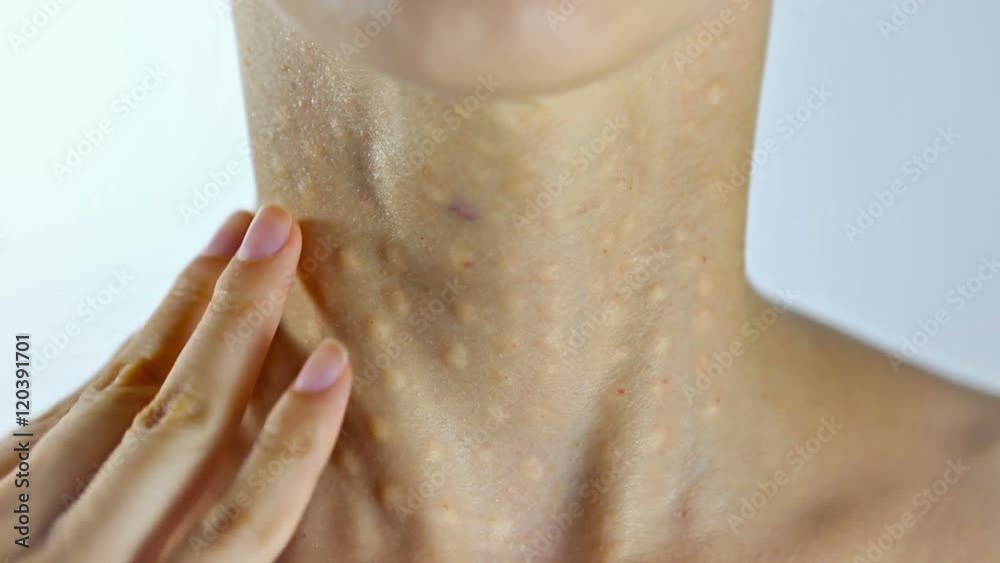 Woman Getting a Beauty Injection in her neck and decollete area. Young