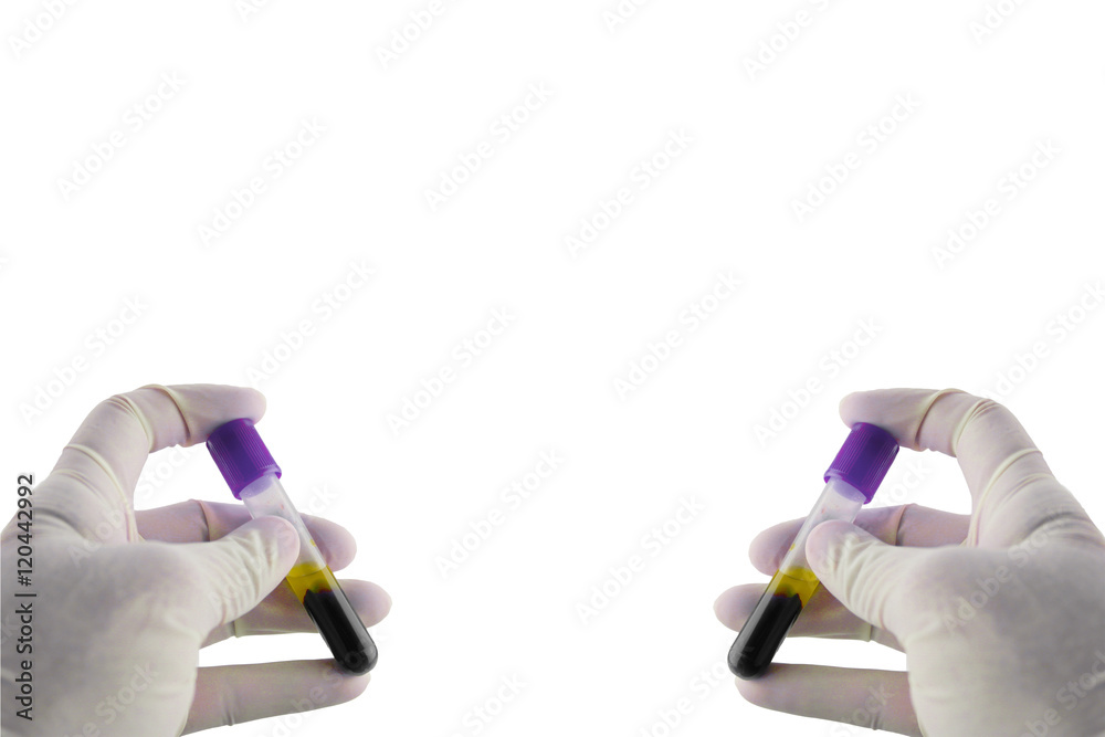 Specimen blood sample for hematology in laboratory,Specimen in Clot