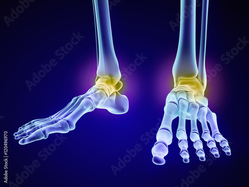 Skeletal foot - injuryd talus bone. Xray view. Medically accurate 3D illustration
