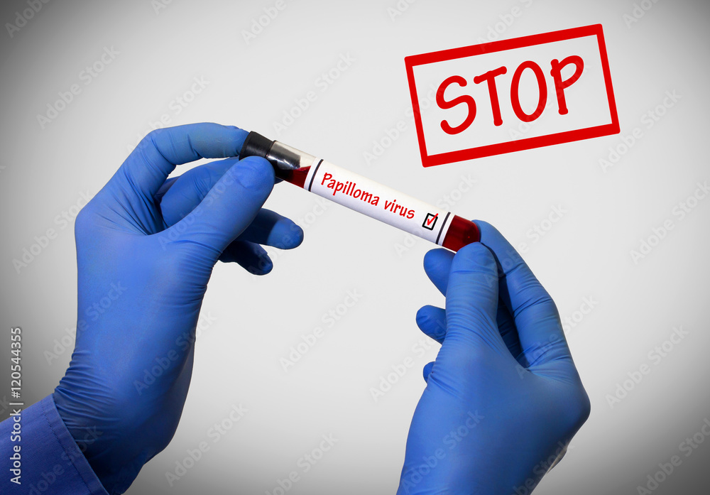 Stop papilloma virus Stop papilloma virus