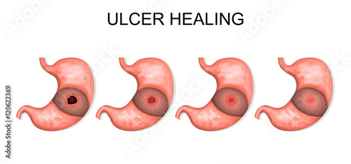 ulcer healing. gastroenterology photo