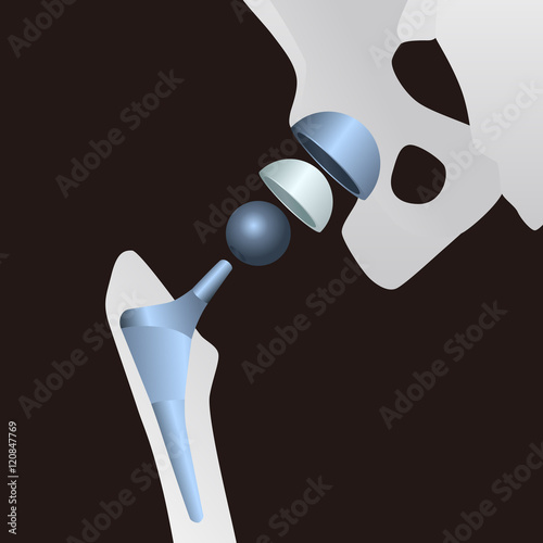 structure of the artificial hip joint, vector illustration