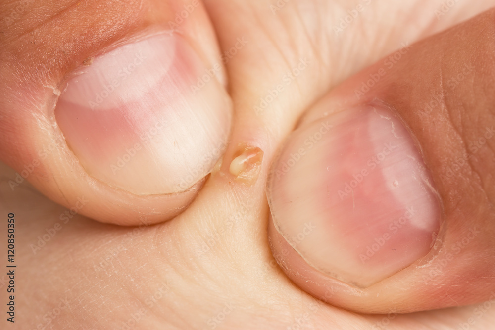 Naklejka premium boil on the skin