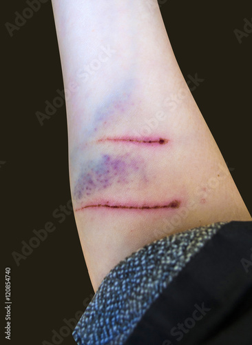 dog bite is. from the dog bite is wound