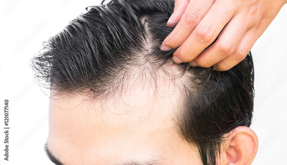 Closeup young man serious hair loss problem for hair loss concep Closeup young man serious hair loss problem for hair loss concep