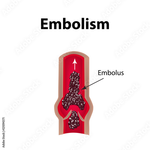 Thrombocytosis. Embolism. Infographics. Vector illustration on isolated background