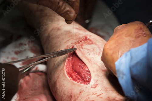 Surgeon begins to sew the wound on the leg after the operation
