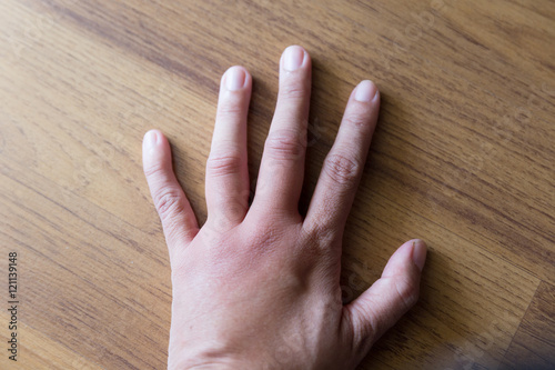 Fotografie, Obraz swollen hand from wasp sting