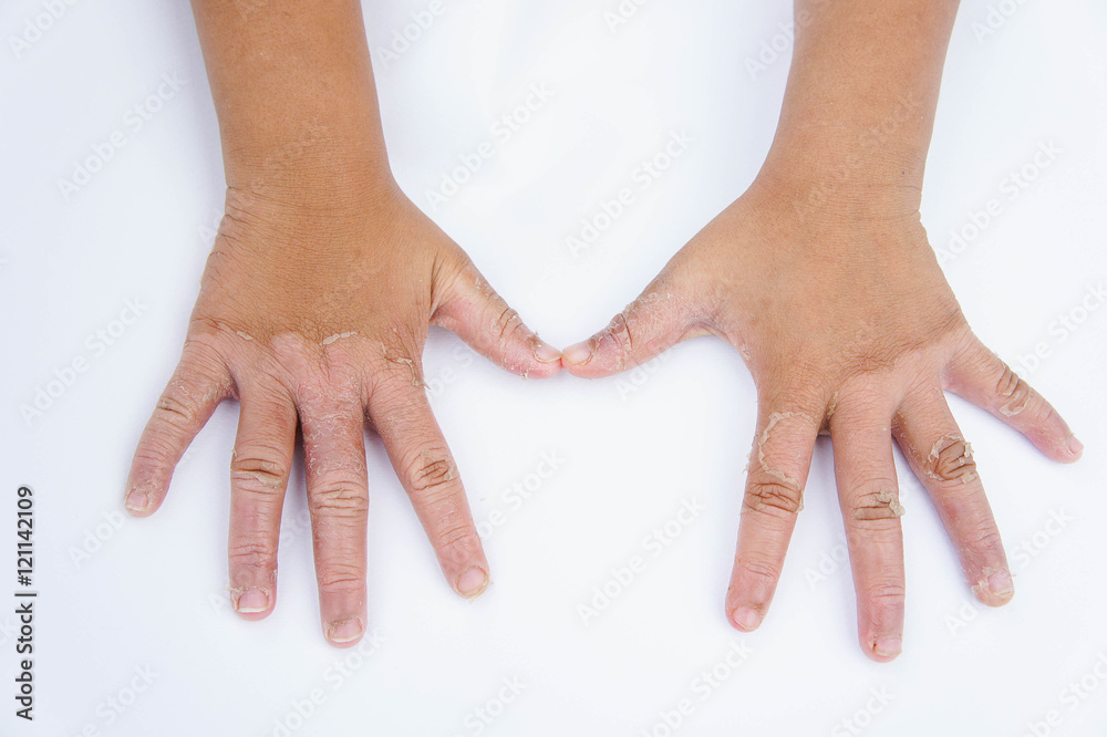 Φωτογραφία Dry hands, peel, Contact dermatitis, fungal infections, Skin inf