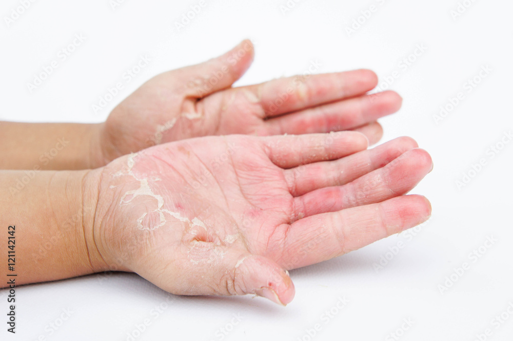 Dry hands, peel, Contact dermatitis, fungal infections, Skin inf Dry hands, peel, Contact dermatitis, fungal infections, Skin inf