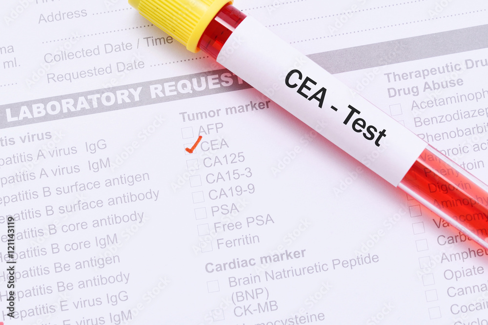 Blood for CEA test, tumor marker for intestinal cancer Stock Photo | Adobe  Stock