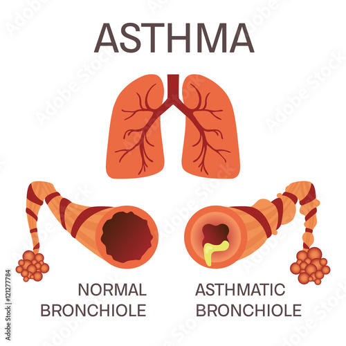 Normal and asthmatic bronchioles on white background. Asthma medical concept. Lungs symbol. Human body organs anatomy icon. Isolated vector illustration.