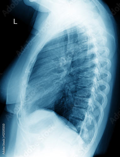 Chest X-ray image of woman photo